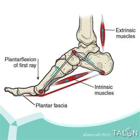 รองช้ำ Plantar Fasciitis