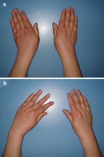 Proximal row carpectomy treatment, etiology, epidemiology, natural history, anatomy, symptoms, xrays, classification, complications and references. Clinical evaluation of proximal row carpectomy revealed by ...