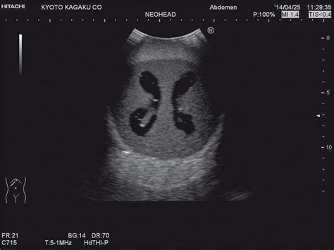 Ultrasound Neonatal Head Phantom With Hydrocephalus Ean 4250395319546