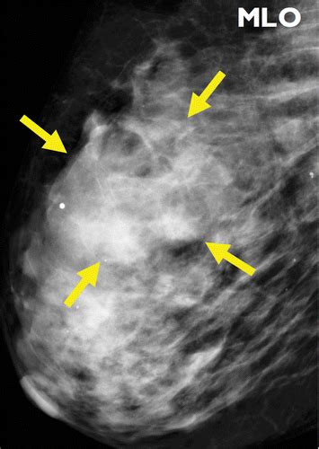 Primary And Secondary Breast Lymphoma Clinical Pathologic And