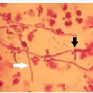 Vitreous Sample Smear With Gram Staining Reveals Fungal My Xxx Hot Girl