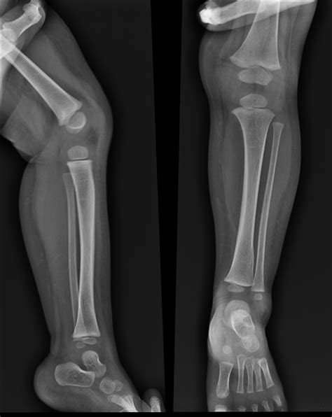 Torsion fracture) is a bone fracture occurring when torque (a rotating force) is applied along the axis of a bone. Toddler fracture | Image | Radiopaedia.org