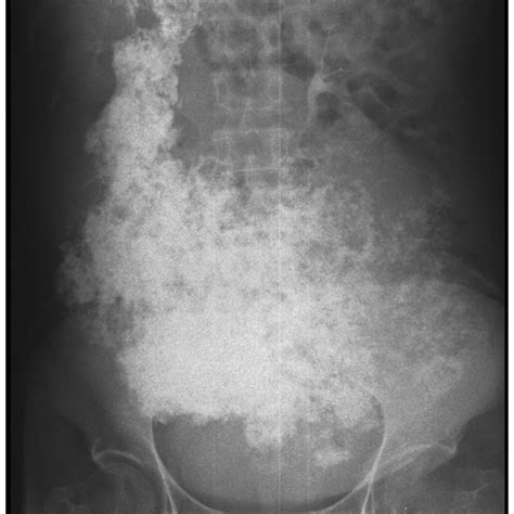 Plain Radiography Showing Extensive Calcifications In The Abdomen