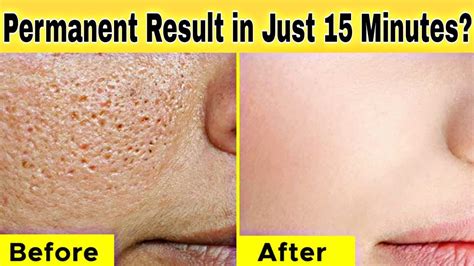 Remove Pimples Acne Dark Spot Instantly With Multani Mitti Face Pack