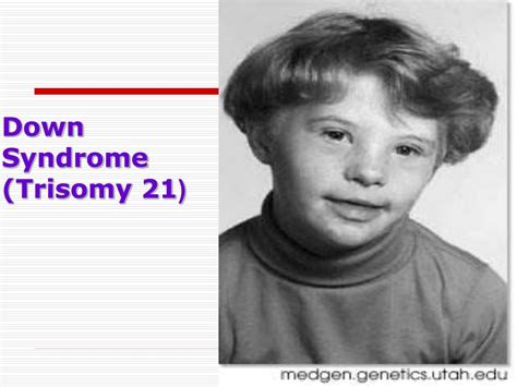 Ppt Down Syndrome Trisomy 21 Trisomy 13 And 18 Powerpoint