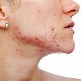 Best Makeup For Combination Acne Prone Skin Images