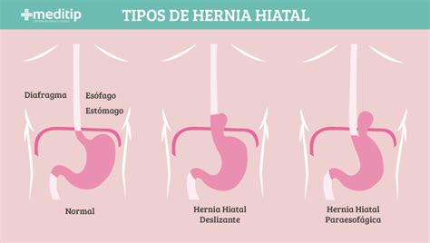 Hernia Hiatal Tipos Causas Síntomas Y Tratamiento