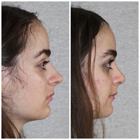 Female Rhinoplasty Westside Face