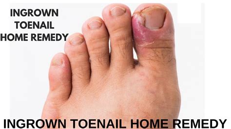 How To Prevent And Heal Ingrown Nails Without Pain Go Get Yourself