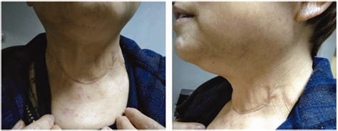 Giant Cervical Goiter In Hashimotos Thyroiditis A Case Report Tang