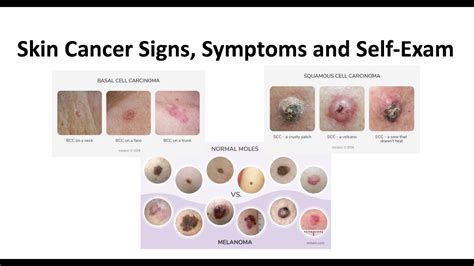 Skin Cancer Signs Symptoms And Self Exam Youtube