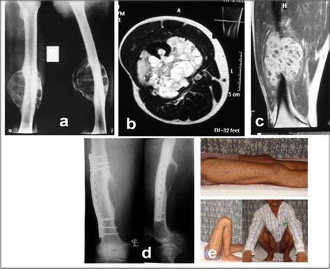 Diaphyseal Aneurysmal Bone Cysts ABCs Of Long Bones In Extremities Analysis Of Surgical