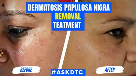 Dermatosis Papulosa Nigra Condition Treatment Dr Rohit Goel Youtube