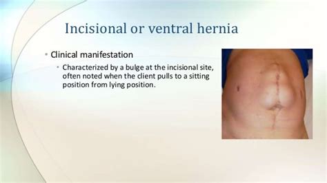 Nursing Care Of Patients With Hernia