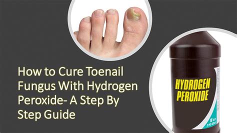 Hydrogen peroxide to foot fungus hydrogen peroxide for foot fungus is one of the common home remedies for this disease. How to Cure Toenail Fungus With Hydrogen Peroxide- A Step ...