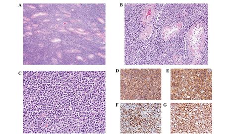 Primary Testicular Diffuse Large B Cell Lymphoma A Case Report