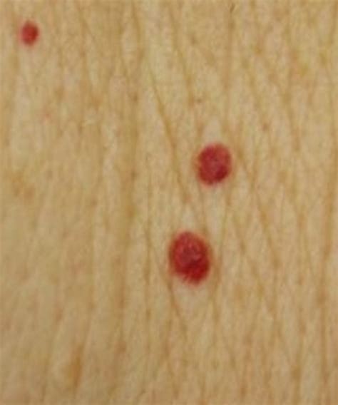 Red Moles Pictures Photos