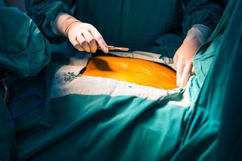 Incision Stock Image Image Of Opening Medical Incision 41064877