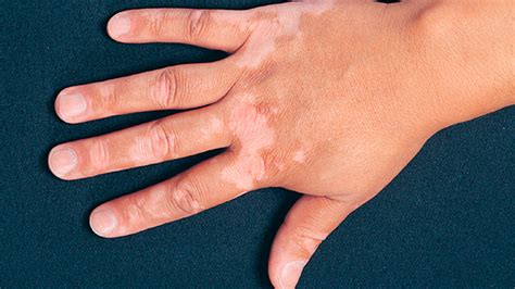 It can also affect hair and the inside of the mouth. Vitiligo - Fundación Mexicana para la Dermatología A.C.
