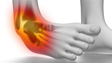 Lateral Ligament Ankle Sprain How To Treat It Properly