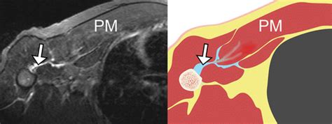 Us And Mr Imaging Of Pectoralis Major Injuries Radiographics