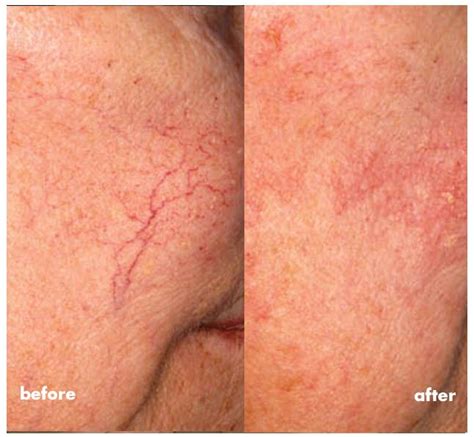 Face Veins Treated In Our Office With Veinwave Veins Treatment