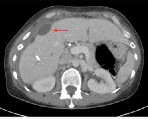 Figure 1 From A Challenging Diagnosis Of Eosinophilic Cholangitis