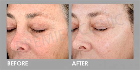 Large Pores Treatment Silkpeel Dermalinfusion Premeir Clinic