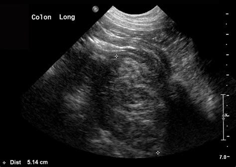 Ultrasonography Of The Gastrointestinal Tract Ileum Cecum Colon