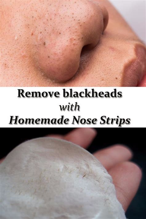 Remove Blackheads With Homemade Nose Strips Nose Strips