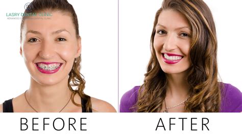 Teeth After Braces Home Care And What To Expect