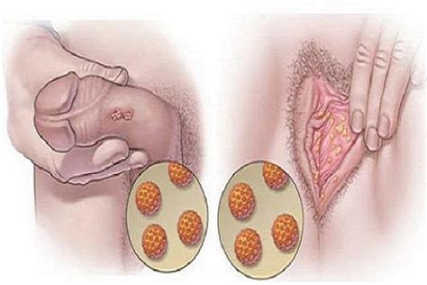Maybe you would like to learn more about one of these? Forma Fácil De Detectar Enfermedades Venéreas Sin Examen ...
