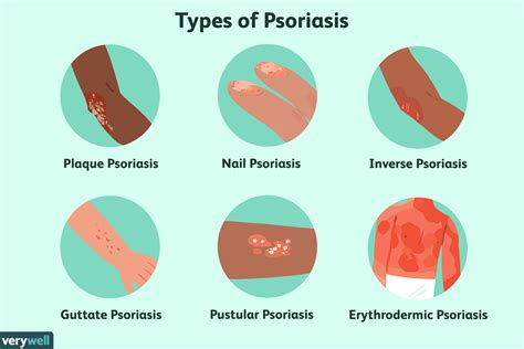 Psoriasis Overview And More