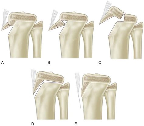 39 Open Reduction And Internal Fixation Of Tibial Tubercle Fractures