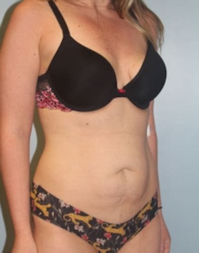 Abdominoplasty Tummy Tuck Before And After Photos Las Vegas