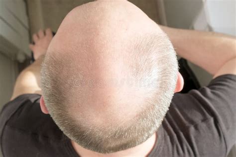 Baldness Man Concerned About Hair Loss Fighting Hair Loss In Men