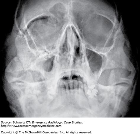 tripod fracture facial fractures orbital ray blowout floor vii chapter