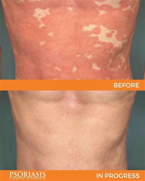 Psoriasis Before Afters Dermatology Clinics Australia