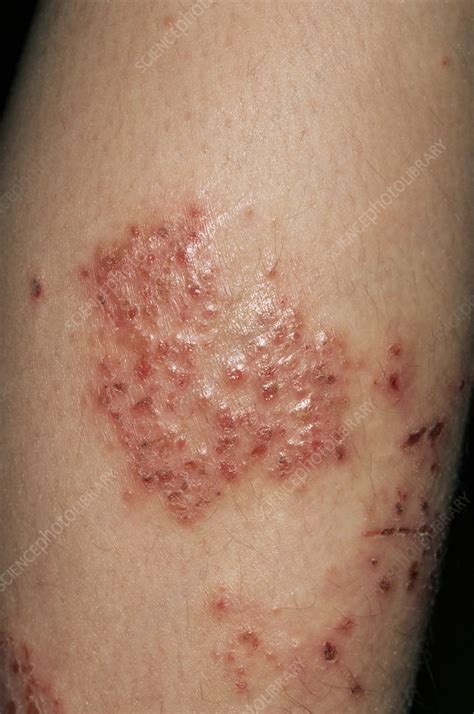 Infected Eczema Stock Image M1500258 Science Photo Library