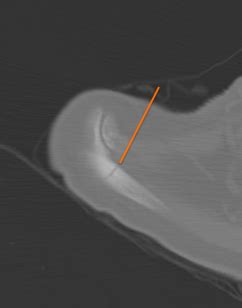 Shoulder Arthritis / Rotator Cuff Tears: causes of ...