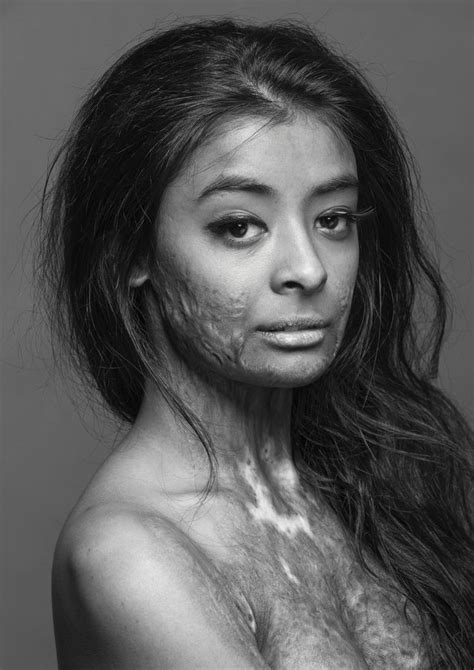 Pin By Thiago Correia On Portrait Burn Survivor Beautiful Models