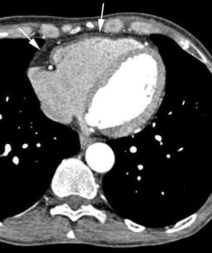 Pericardial Disease Value Of Ct And Mr Imaging Radiology