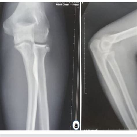 A And B Follow Up X Ray Left Elbow Anterior Posterior And Lateral