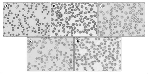 Four out of nine family members had hereditary elliptocytosis. Peripheral blood smear of inherited hemolytic anemia. (A ...