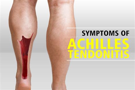 The Causes And Symptoms Of Achilles Tendonitis Activegear