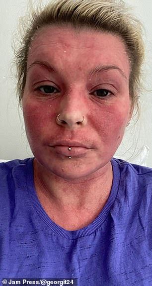 Woman Reveals How Steroid Creams Prescribed For Her Eczema Left Her