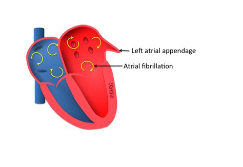 Left Atrial Appendage Occlusion The Birmingham Heart Rhythm Group