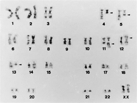 Complex Karyotype And N Ras Point Mutation In A Case Of Acute