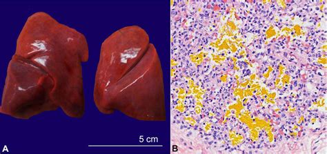 Yellow Hyaline Membrane Disease A Gross Image Showing Bilateral