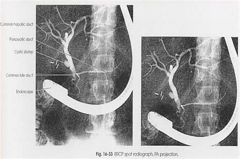 Radiologi Yahuuut Teknik Radiografi Endoscopic Retrograde Cholangio
